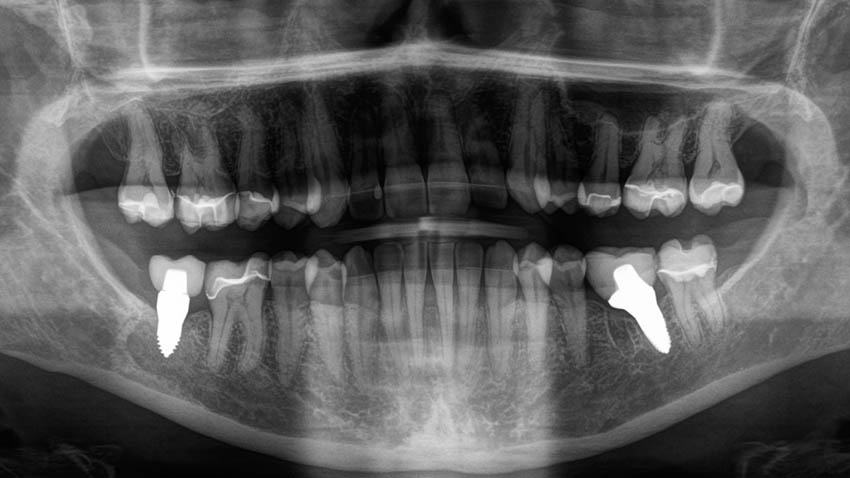 Gebiss von Patientin Jacqueline Bussard nach der Zahn-Op mit Keramikimplantaten