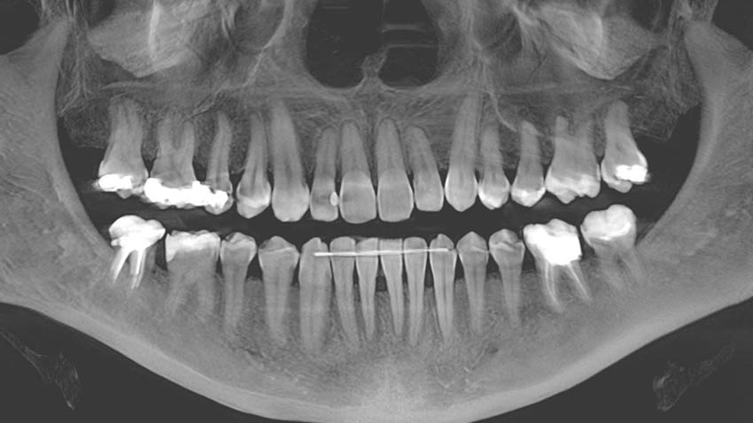 Gebiss von Patientin Jacqueline Bussard vor der Zahn-Op