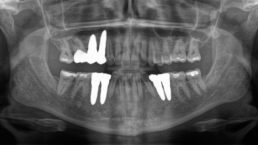 Dentition after restoration with ceramic implants