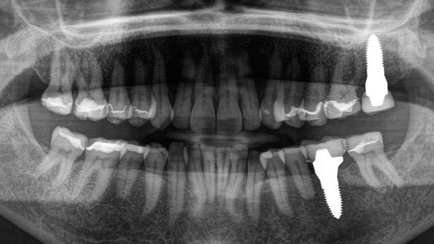Gebiss von Cynthia Milne nach der Zahnbehandlung mit Implantaten