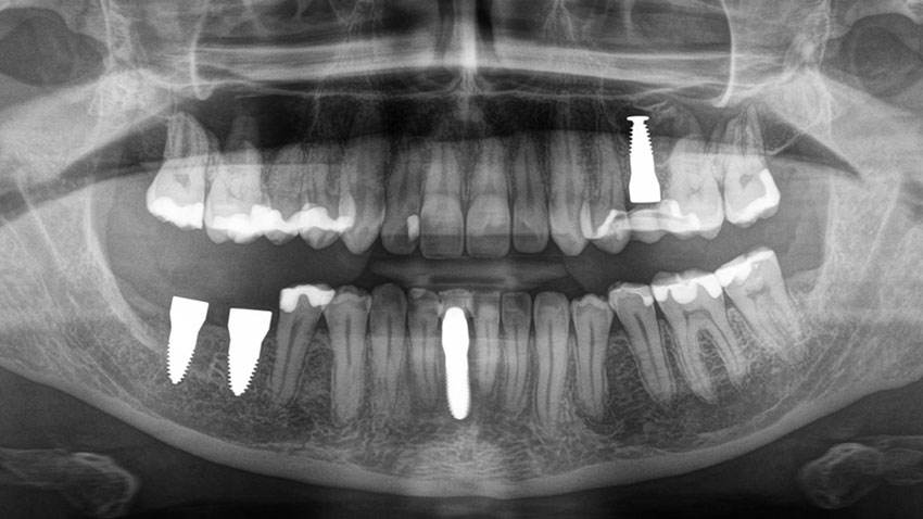 Cornelia H.'s denture after titanium implant removal