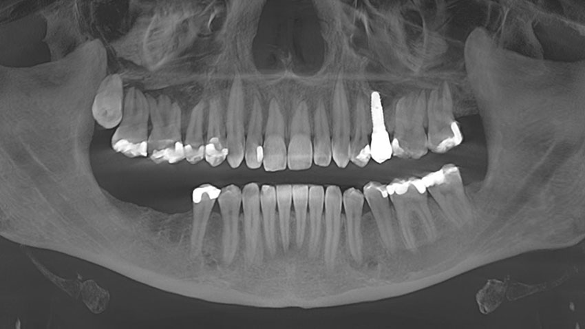 Cornelia H.'s denture with titanium implant